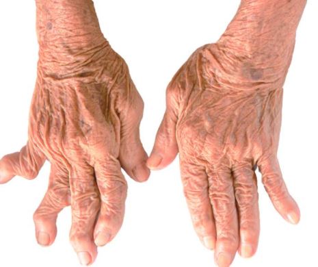 Reasons and Symptoms for rheumatoid arthritis