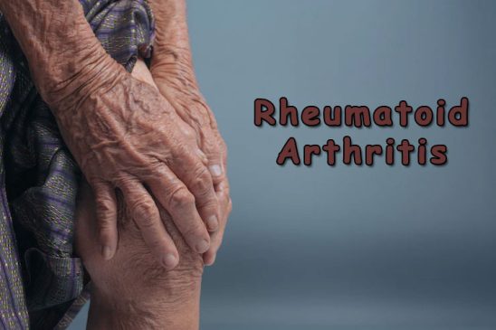 Rheumatoid Arthritis