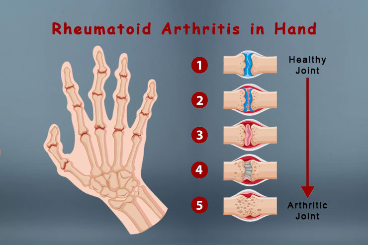 Rheumatoid Arthritis in Hand